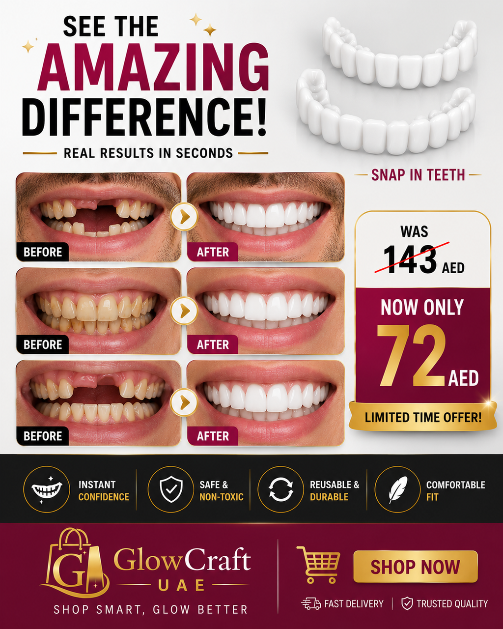 Before and after comparison of snap-in teeth veneers for a brighter, complete smile.